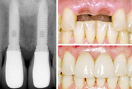2 Implants for 2 missing front teeth