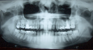 [CT Scan Image: Close-up of jaw]