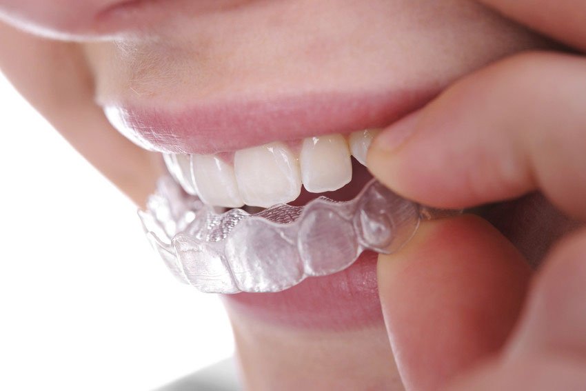 Orthodontics - Invisible Braces